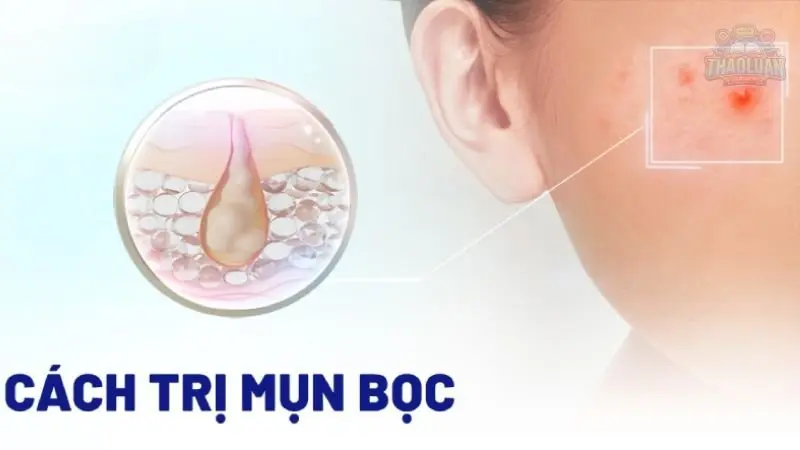10 câu hỏi về mụn bọc và cách trị mụn bọc