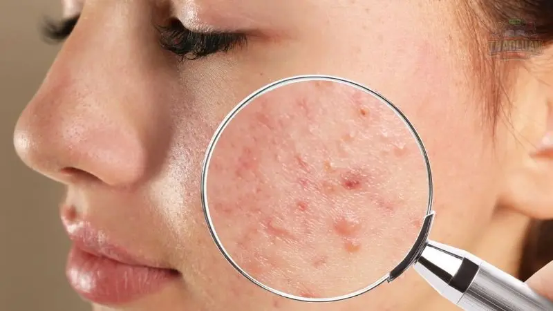 13 cách trị mụn tại nhà an toàn không phải ai cũng biết