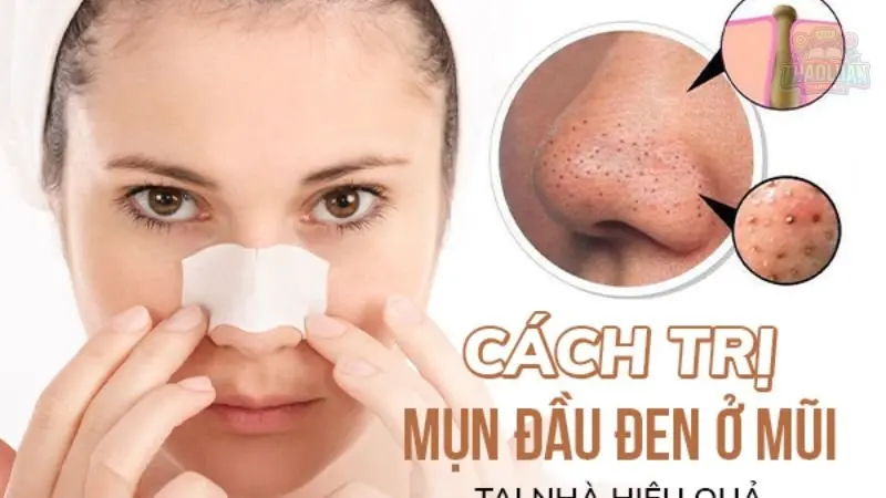 9 cách trị mụn đầu đen tại nhà không phải ai cũng biết