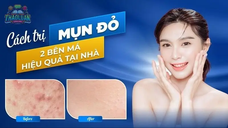 Cách trị mụn đỏ 2 bên má tại nhà đơn giản hiệu quả cấp tốc 