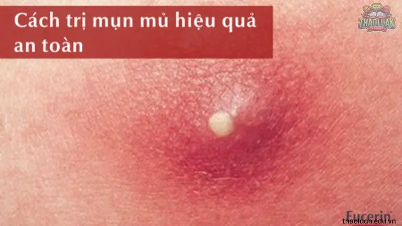 Hướng dẫn cách chữa mụn nhọt tại nhà an toàn và hiệu quả