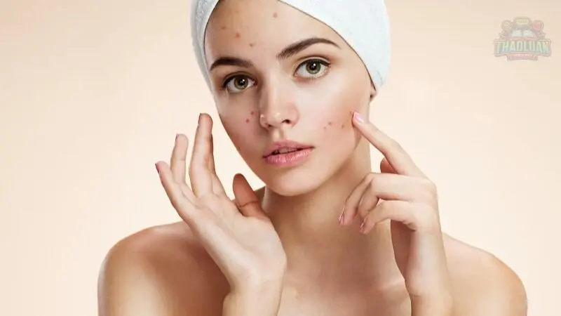 Hướng dẫn cách trị mụn thâm đơn giản tại nhà hiệu quả cao