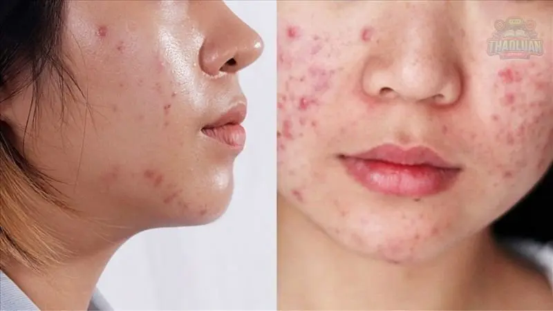 Top 5 loại thuốc trị mụn bác sĩ khuyên dùng