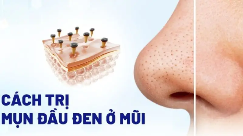 Top 7 cách trị mụn đầu đen ở mũi tại nhà không phải ai cũng biết