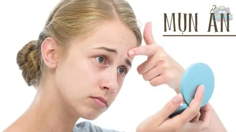 12 cách trị mụn ẩn dưới da hiệu quả được bác sĩ da liễu tin dùng