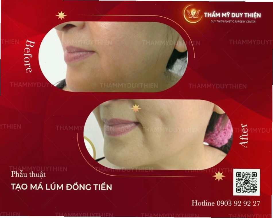 Kết quả tạo má lúm đồng tiền