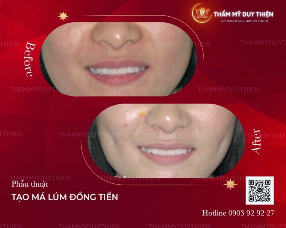 Quy trình tạo má lúm đồng tiền