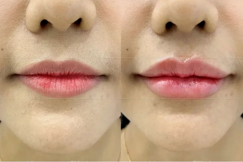 Tiêm filler tạo hình môi trái tim quyến rũ