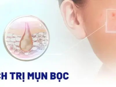 10 câu hỏi về mụn bọc và cách trị mụn bọc