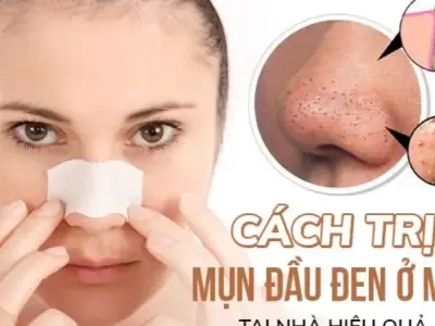 9 cách trị mụn đầu đen tại nhà không phải ai cũng biết