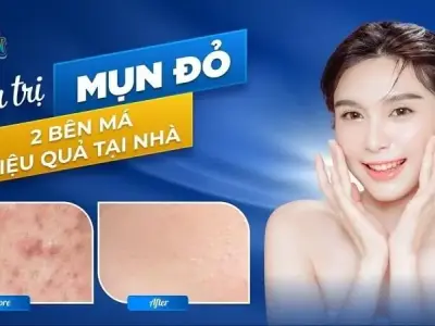 Cách trị mụn đỏ 2 bên má tại nhà đơn giản hiệu quả cấp tốc 