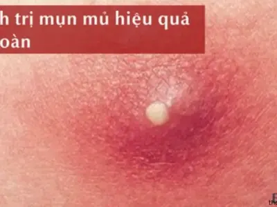 Hướng dẫn cách chữa mụn nhọt tại nhà an toàn và hiệu quả