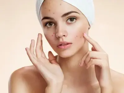 Hướng dẫn cách trị mụn thâm đơn giản tại nhà hiệu quả cao