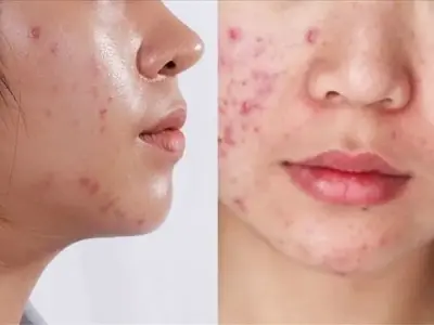 Top 5 loại thuốc trị mụn bác sĩ khuyên dùng