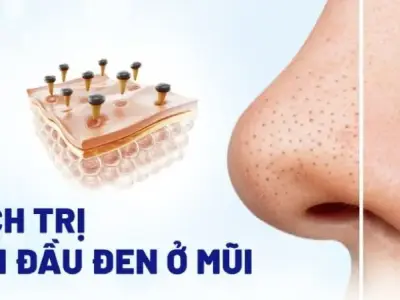 Top 7 cách trị mụn đầu đen ở mũi tại nhà không phải ai cũng biết