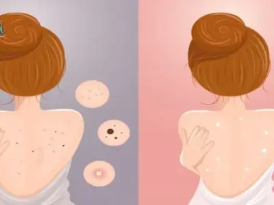 Top 7 cách trị mụn lưng tại nhà cực kì hiệu quả