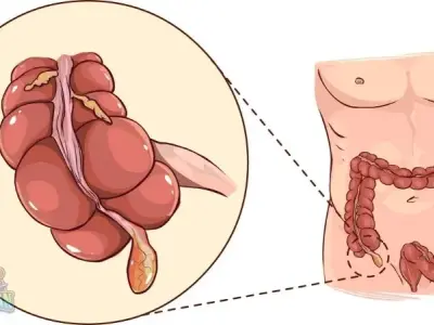 10 Cách nhận biết đau ruột thừa bạn nên biết sớm