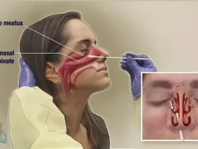 Ung thư vòm họng ở giai đoạn đầu - Cách nhận biết ung thư sớm