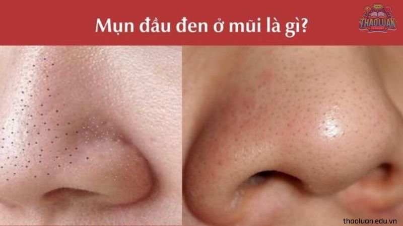 Mụn đầu đen là gi? 1 