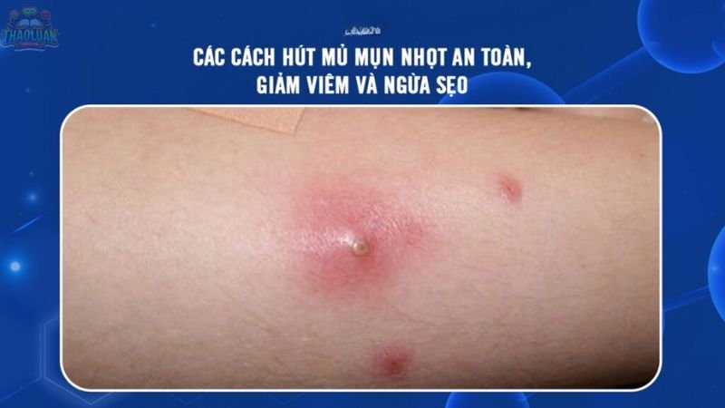 Các cách chữa mụn nhọt tại nhà 3