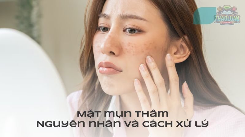 Các cách trị mụn thâm tại nhà hiệu quả cao 5