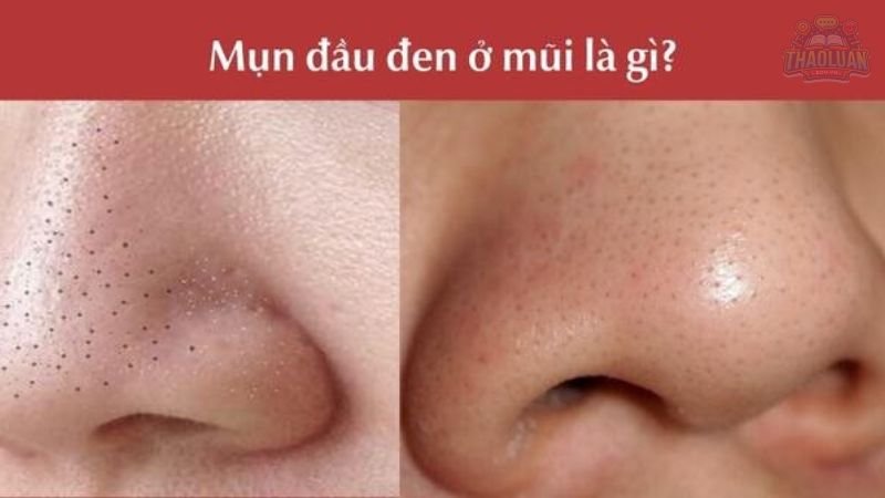 Định nghĩa mụn đầu đen? 1 