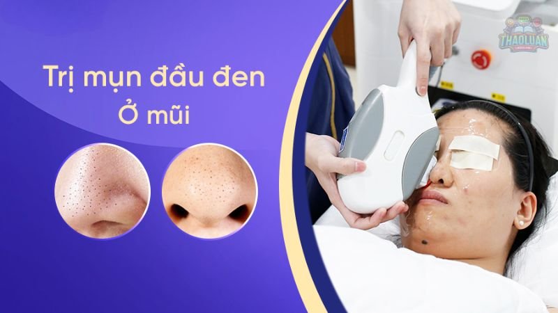 7 cách trị mụn đầu đen tại nhà 3