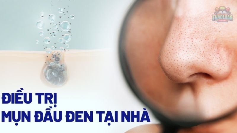 7 cách trị mụn đầu đen tại nhà 2