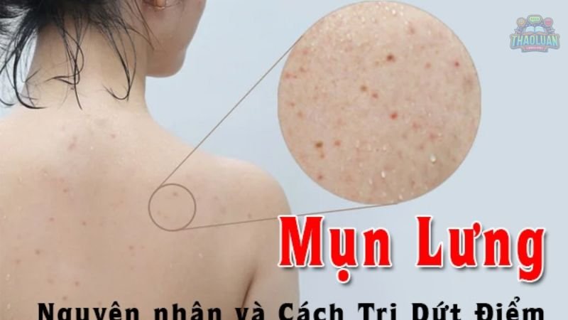 Lưu ý khi trị mụn lưng tại nhà 9