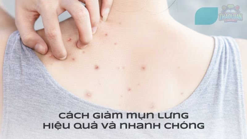 7 cách trị  mụn lưng tại nhà 7