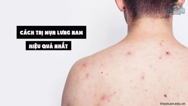 7 cách trị  mụn lưng tại nhà 5