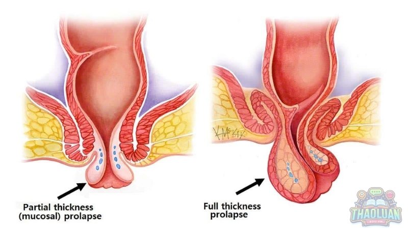 Nguyên tắc hoạt động của phương pháp nhận biết sa tử cung bằng tay