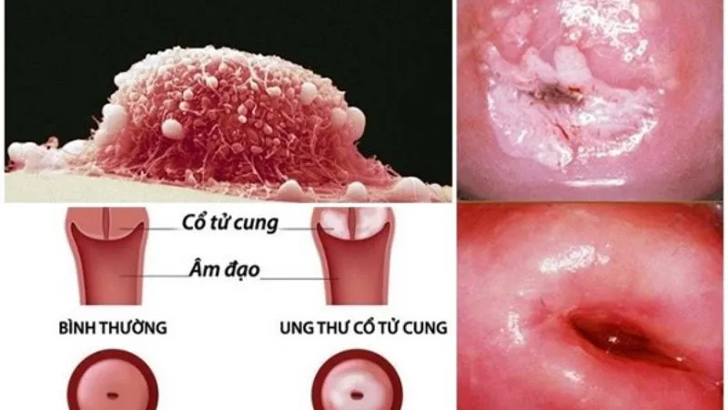 Ung thư cổ tử cung là gì? 1