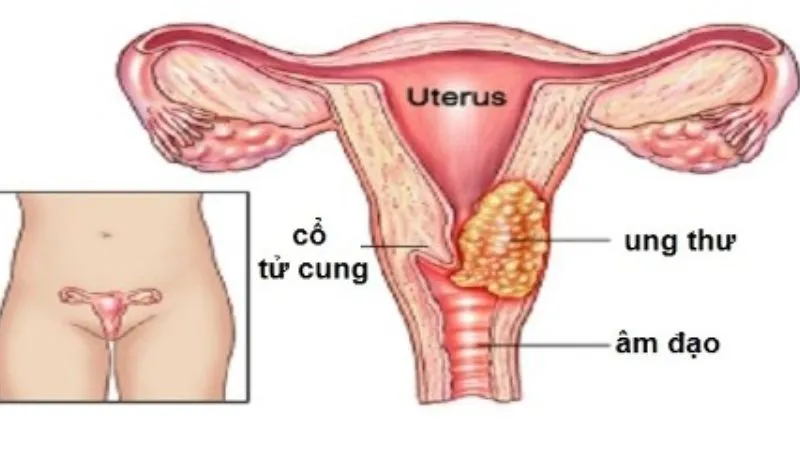 Triệu chứng của ung thư cổ tử cung 2