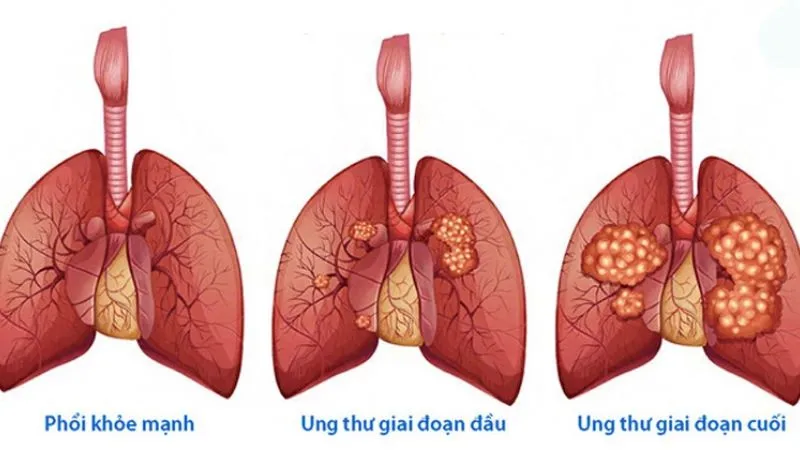 Các giai đoạn của bệnh u phổi ác tính