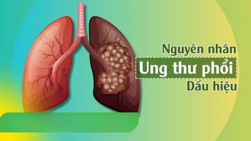 Nguyên nhân gây ung thư phổi