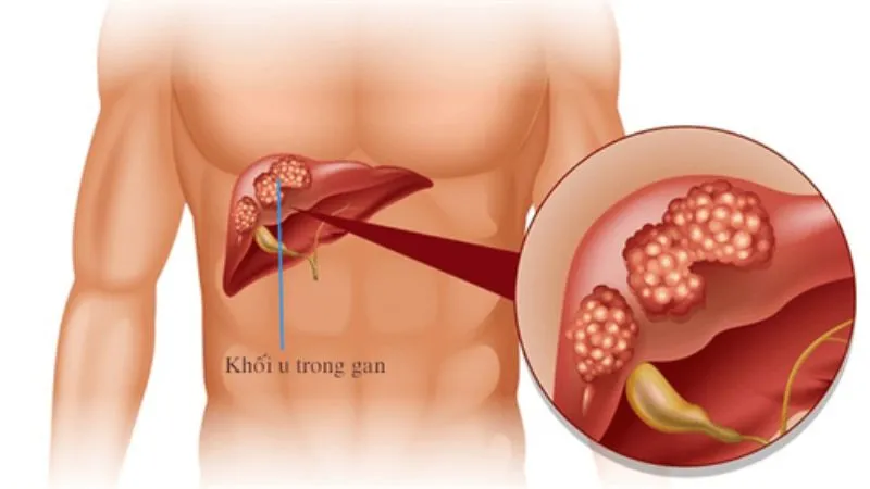 Nguyên nhân và các yếu tố gây ra bệnh ung thư 2