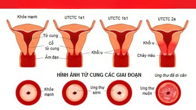 Các bệnh ung thư thường gặp