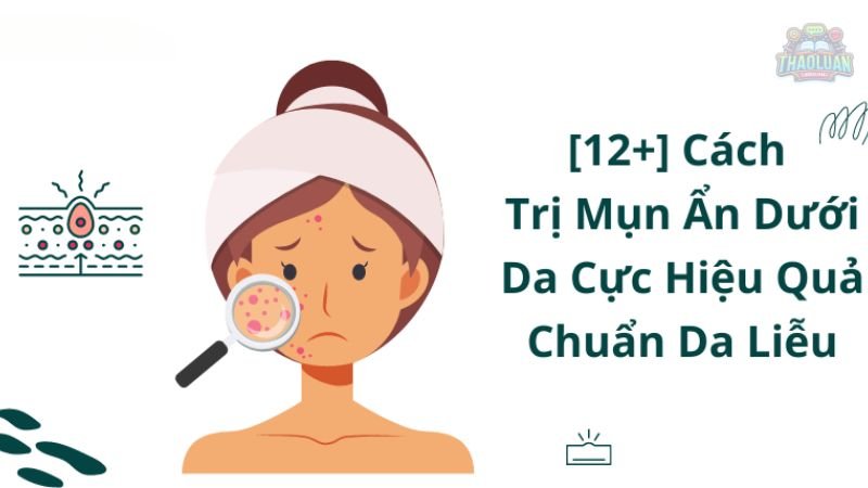 12 cách trị mụn ẩn hiệu quả 3